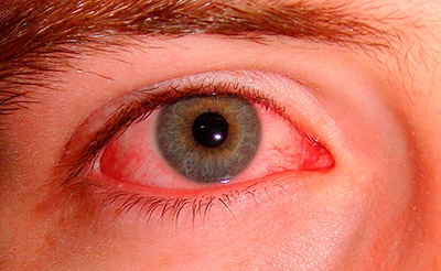 conjuntivitis-y-lentillas-ojo-rojo